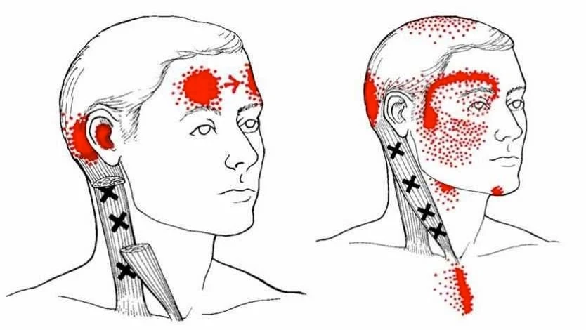 Tekening van triggerpoints in de nekspieren en de uitstralende pijn naar het hoofd